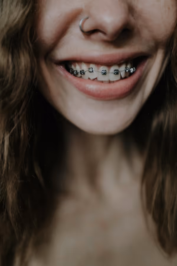 Mulher sorrindo e exibindo aparelho ortodôntico